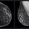 L’IA di Google contro il cancro al seno: iCAD la user per le mammografie